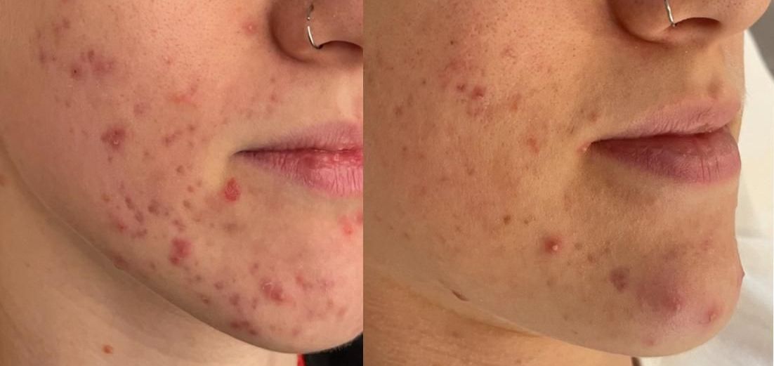 acne trattate con acido salicilico contenuto nel prodotto penetra nella ghiandola sebacea e riduce la produzione di sebo