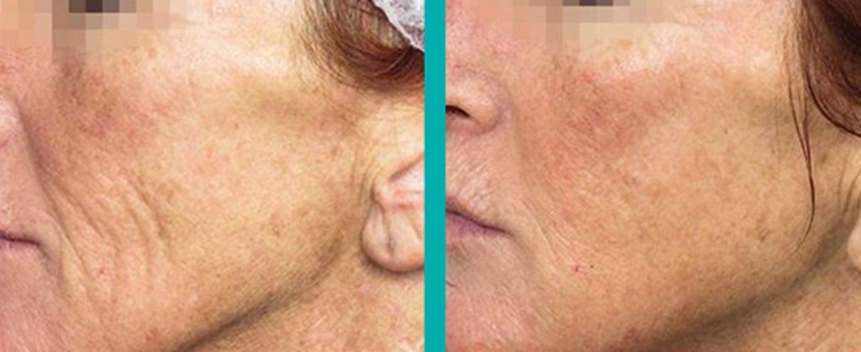 Il peeling è una tecnica a base di agenti chimici acidi che elimina le cellule della pelle a vario grado di spessore a seconda della concentrazione dell'acido utilizzato. Ha quindi la finalità di promuovere la ristrutturazione della pelle.